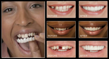 Snap-On Smile