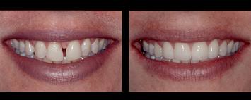 Veneers